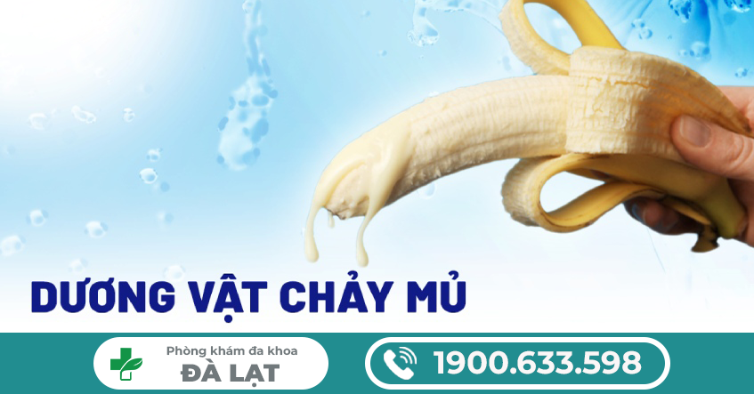 CÁCH CHỮA DƯƠNG VẬT CHẢY MỦ
